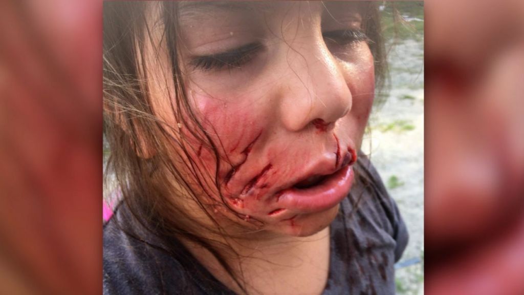Une fillette de 9 ans défigurée par un boxer - TVA CIMT CHAU